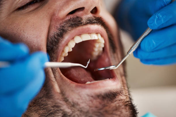 Best Emergency Wisdom Tooth Extraction in Emory, TX